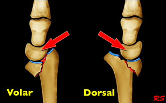 <p>What is an <strong>intra-articular fracture</strong> of the distal radius w/ dislocation of the radoiocarpal joint?</p>