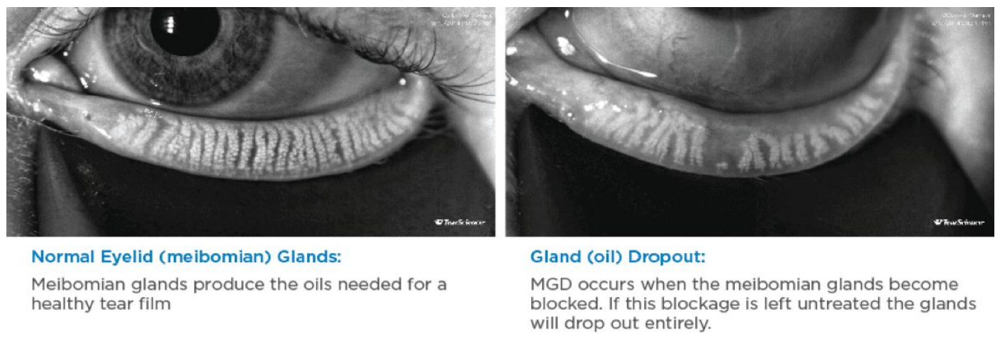 <p>Name this clinical condition </p>