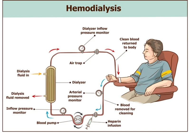 <ul><li><p class=""><span style="color: red">Synthetic membrane </span><span style="color: #13ed08">outside the body</span></p></li><li><p class="">Arterial blood pumped through dialysate at high speed</p></li><li><p class="">Blood returned to venous circulation;<span style="color: red"> dialysate discarded</span></p></li></ul><p></p>