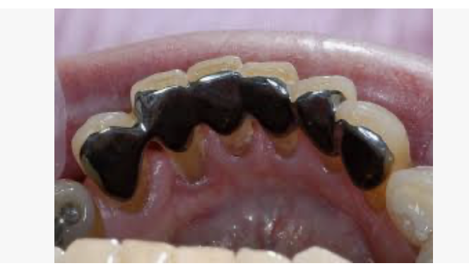 <p>In this design there is no need to make any surface modification before casting, after casting, we clean the surfaces with air abrasion, then prepare the retainer inner surface fro adhesion by various methods. The bond in this design depends on the inherent bond ability of the newer resin cement to the alloy.</p>