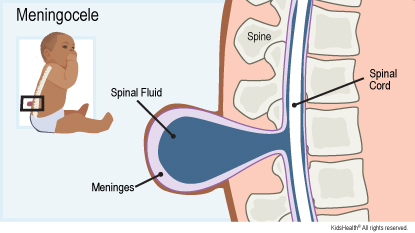 <p>Meningocele</p>