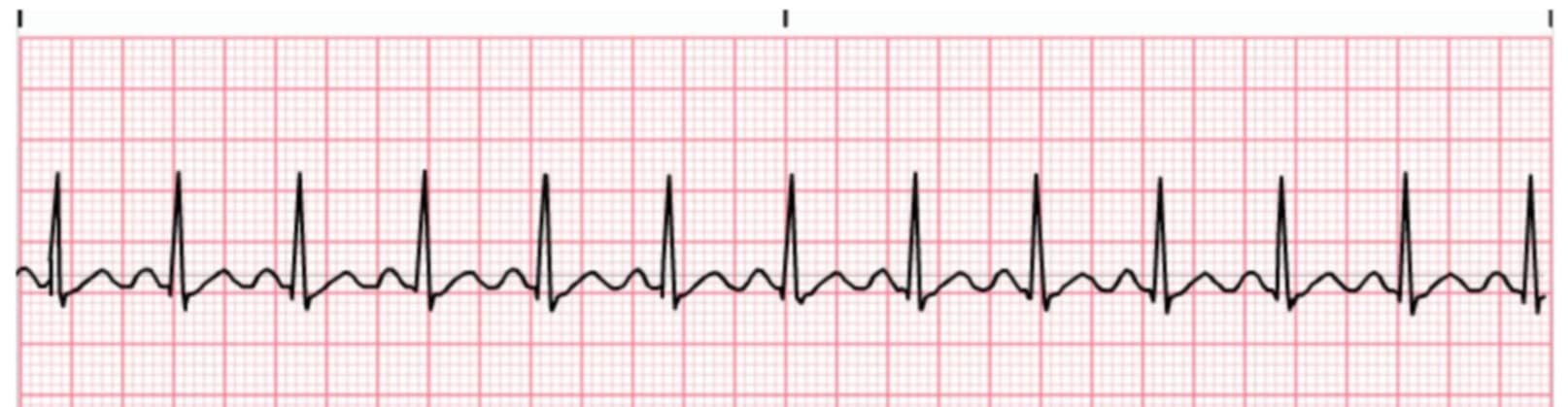 <p>what rhythm is shown in the ECG?</p>