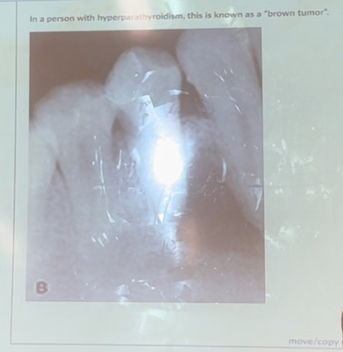 <p>In a person with hyperparathyroidism, this is known as a "brown-tumor".</p>