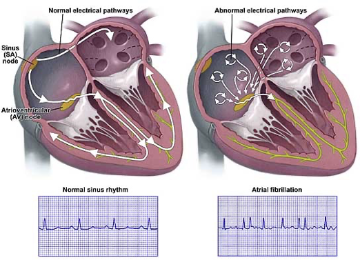 <p>atrial fibrillation</p>