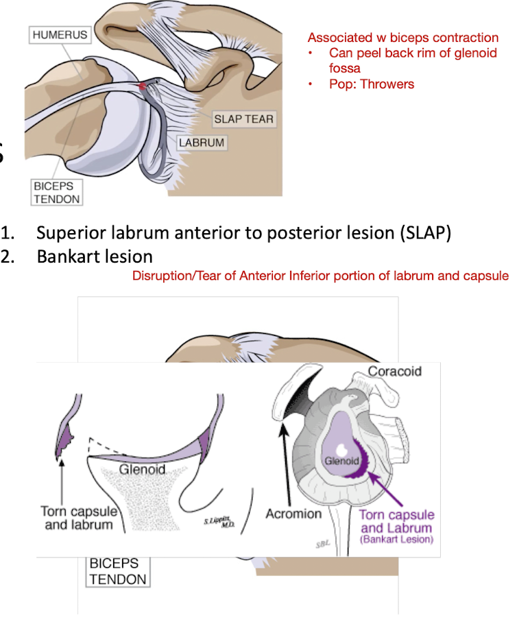 <ul><li><p>Superior Labrum Anterior to Posterior Lesion (SLAP)</p></li><li><p>Bankart Lesion </p></li></ul><p></p>