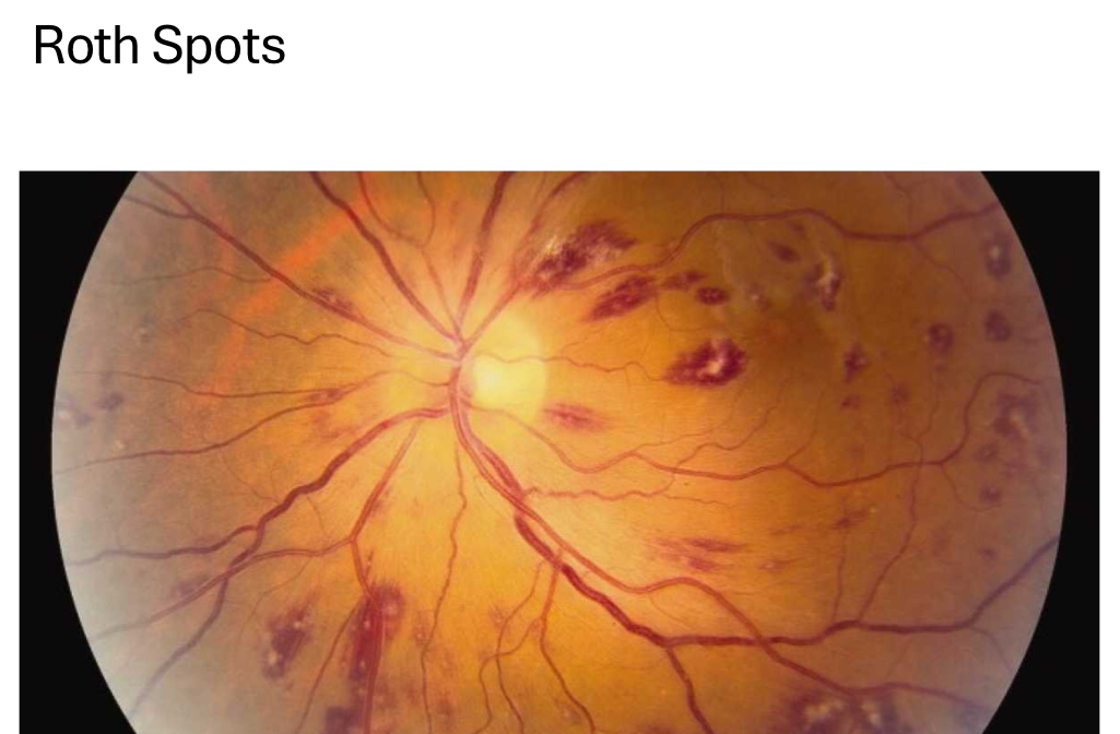 <p>blot or flame hemorrhage</p>