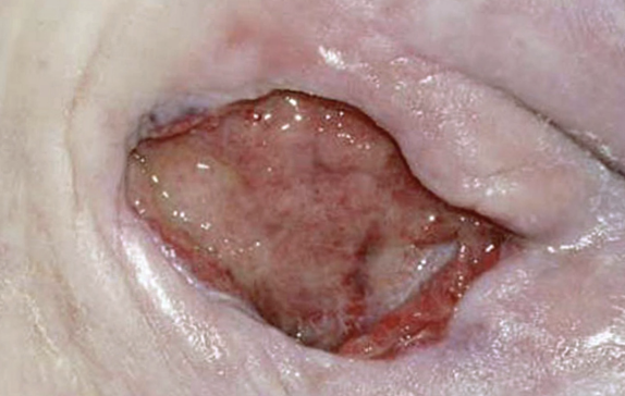 <p>A patient has a grade 3 pressure ulcer. The wound has excessive amounts of exudate present. Which of the following is the MOST APPROPRIATE dressing to use?</p><ol><li><p>hydrofiber dressing</p></li><li><p>hydrocolloid dressing</p></li><li><p>hydrogel dressing</p></li><li><p>transparent film</p></li></ol><p></p>