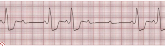 <p>Identify what type of heart block is shown! Discuss symptoms </p>