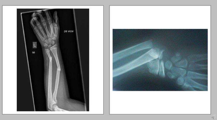 <ul><li><p>BBF - both bone fracture usually requires percutaneous pinning </p></li><li><p>proximal third radial or ulnar - immobilize elbow&nbsp;</p></li><li><p>mid forearm radial/ulnar BBF&nbsp;</p></li><li><p>Distal third of forearm (radial ulnar of BBF)</p><ul><li><p>immobilize the wrist&nbsp;</p></li><li><p>align wrist at 0 degrees extension - not functional position </p></li><li><p>fracture orthosis with palmar extension (pre-fab)</p></li></ul></li></ul><p></p>