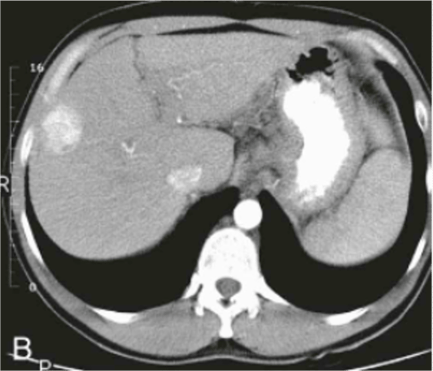 <p>most common primary malignant hepatic tumor</p>