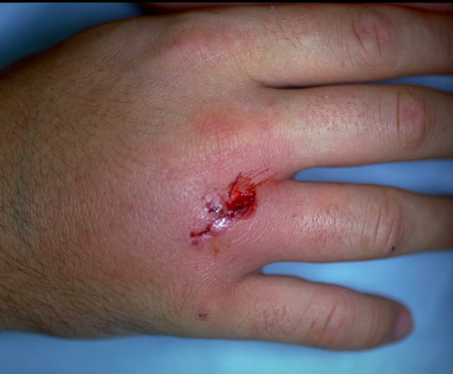 <p>Eikenella corrodens</p>