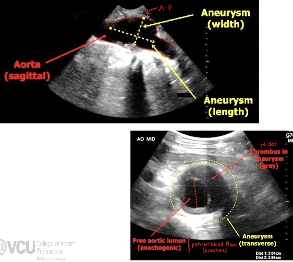 <ul><li><p><u>size</u> (L x W x H in LONG and TRANS)</p></li><li><p><u>shape</u> (fusiform or saccular)</p></li><li><p><u>location</u> (infrarenal?)</p></li><li><p>is there wall thickening, calcification, blood flow, or plaque?</p></li></ul><p></p>