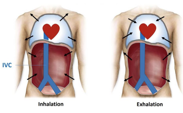 <ul><li><p>IVC ascends in abdomen and thorax</p></li><li><p>does not have skeletal muscle pump, assist from diaphragm</p></li><li><p>inhalation - diaphragm flattens </p><ul><li><p>increases abdominal pressure </p></li><li><p>lowers thoracic pressure </p></li><li><p>blood in IVC pushed towards heart</p></li></ul></li></ul><p></p>