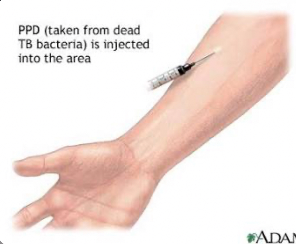 <ul><li><p>used to detect TB infelction</p></li><li><p>injecting small amt of PPD under forearm  skin ( a protein derived from TB bacteria) </p><ul><li><p>if it swells / turns red, it indicates the patient has been infected with TB ( does NOT  mean they have an active TB disease) </p></li></ul></li></ul><p></p>