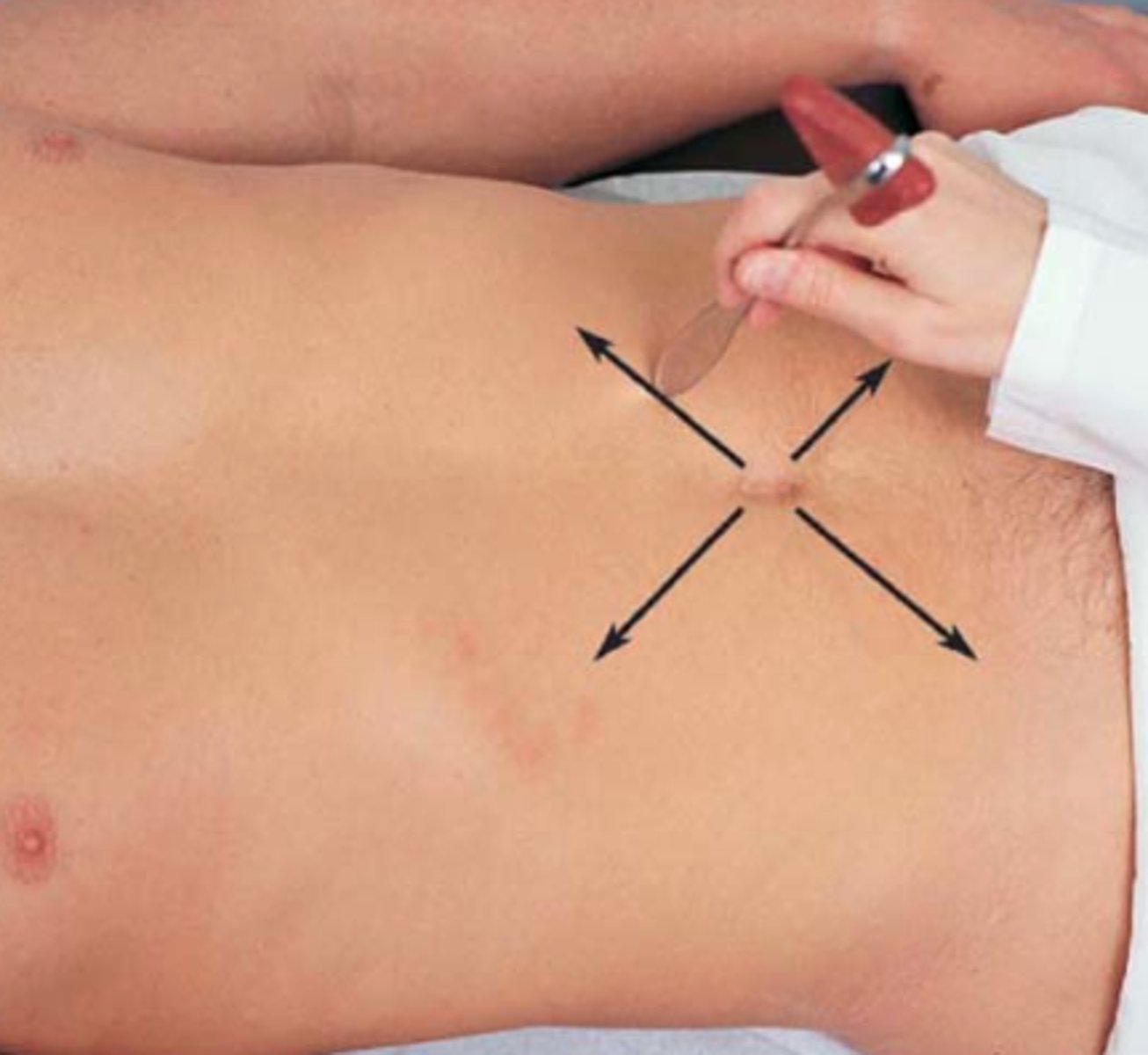 <p>Normal response is the ipsilateral contraction of the abdominal muscles with an observed deviation of the umbilicus towards the stroke.</p>