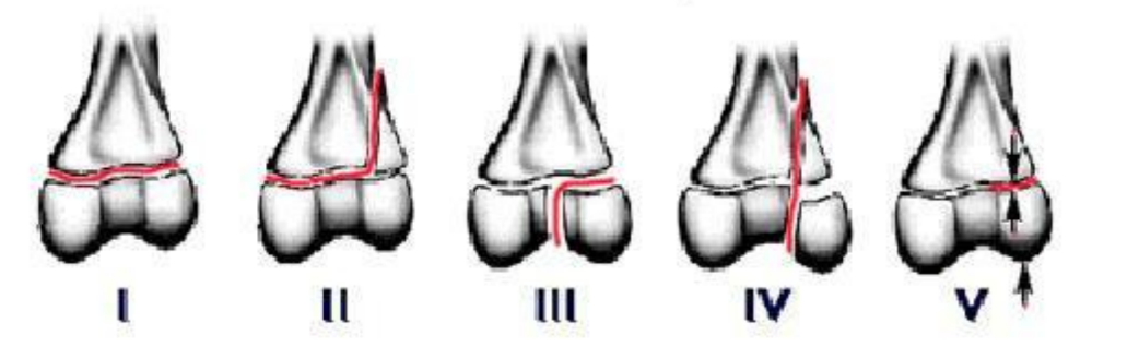 <p>Fractures seen in young growing dogs can be classified into?</p>