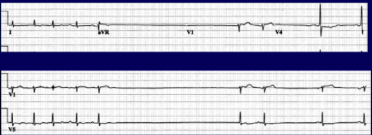 <p>22 yo male basketball player with tooth fracture. He is rambling about nearly passing out at practice and his recent “decline in game”. Half listening, you figure you’ll quiet the excuses. You inject a subcutaneous anesthetic (the mixture contains epinephrine). He suddenly complains of lightheadedness. He is pale and intermittently alert before ultimately blacking out. </p><p>What should be done next? (bradycardia)</p>
