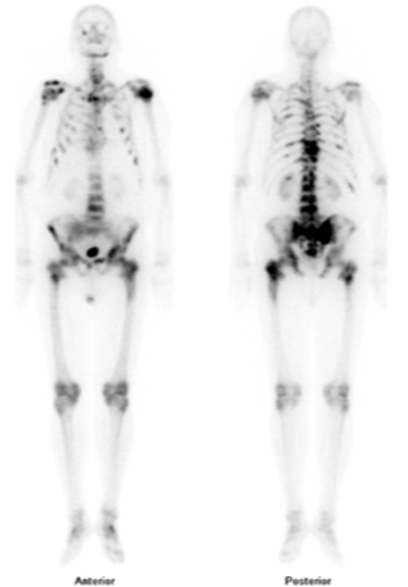 <p>State the clinical findings of skeletal metastasis</p>