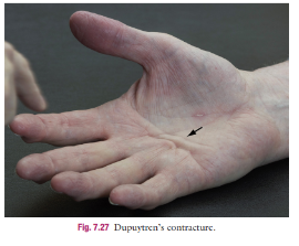 <p><span><strong>Dupuytren’s Contracture&nbsp;</strong></span></p>