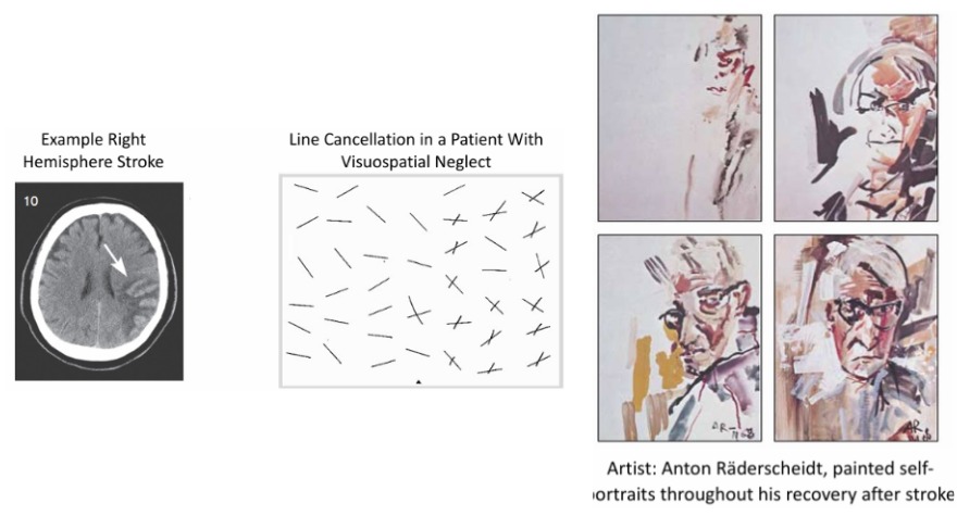 <p>Visuospatial neglect is an attentional disorder in which patients fail to acknowledge objects or events in the space opposite (contralateral) to their brain lesion. It commonly occurs after a right hemisphere stroke, causing patients to ignore the left side of their environment. A prominent feature is extinction, where the patient cannot perceive or respond to stimuli on the neglected side, such as missing lines on a line cancellation task.</p>