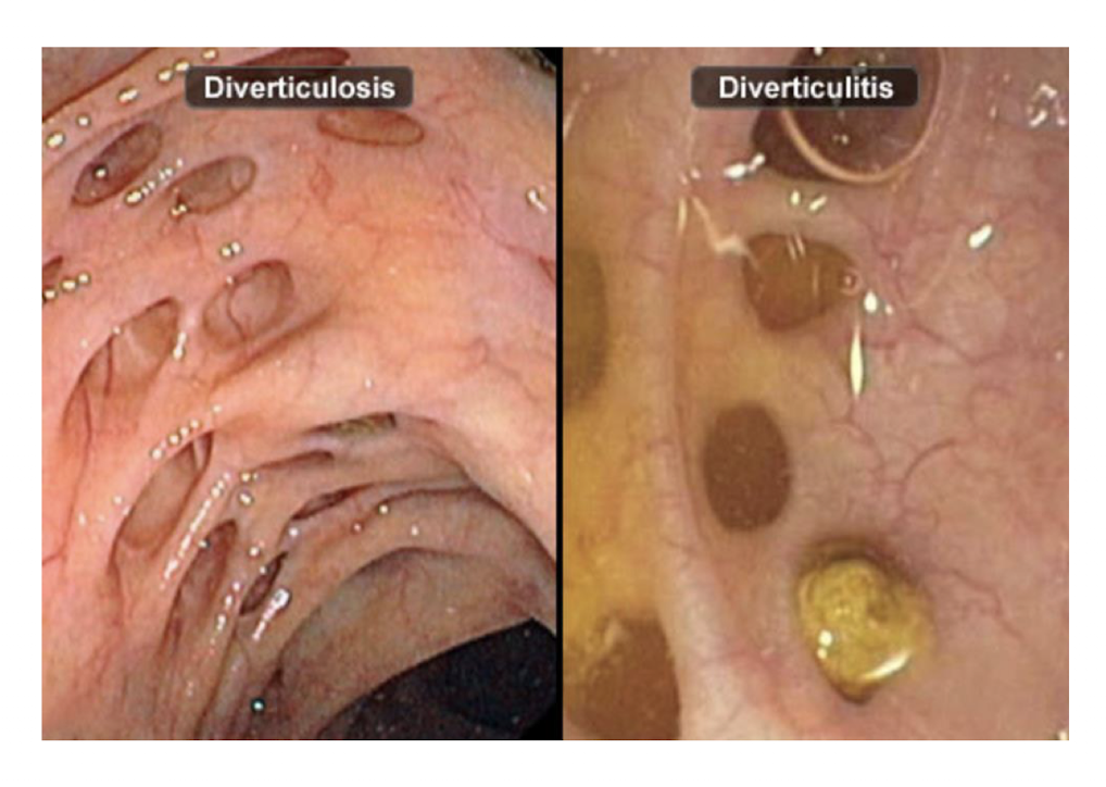 <p>DiverticulOSIS:</p><ul><li><p>What is it?</p></li><li><p>Where do the outpouchings herniate from?</p></li><li><p>More chronic form can be seen throguh where? </p></li></ul><p></p>
