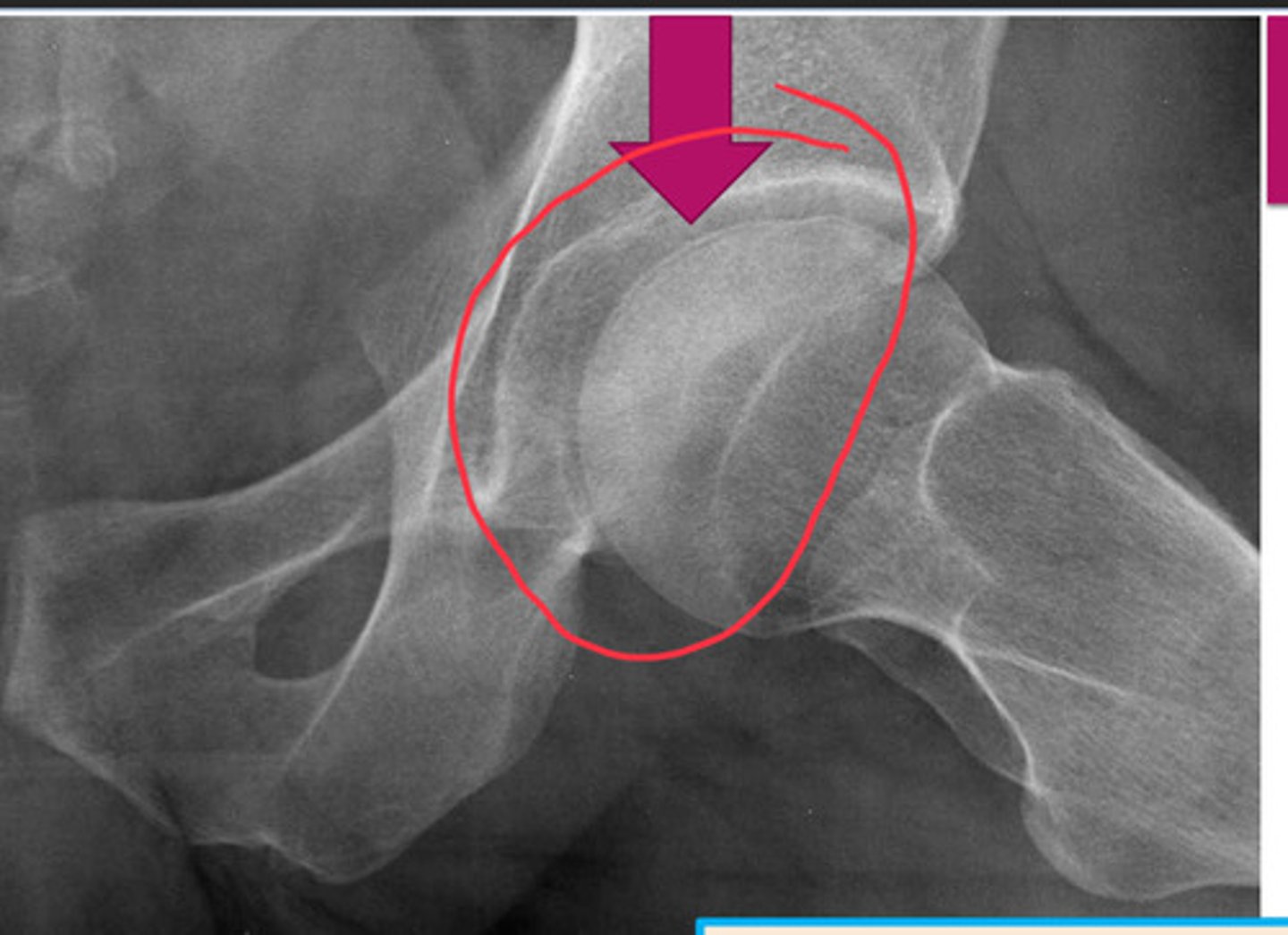 <p>occurs when surface of articular surface is flattening (DO NOT MISS! PRECURSOR TO WORSENING DISEASE!)</p><p>pictured: AVN of femoral head</p>