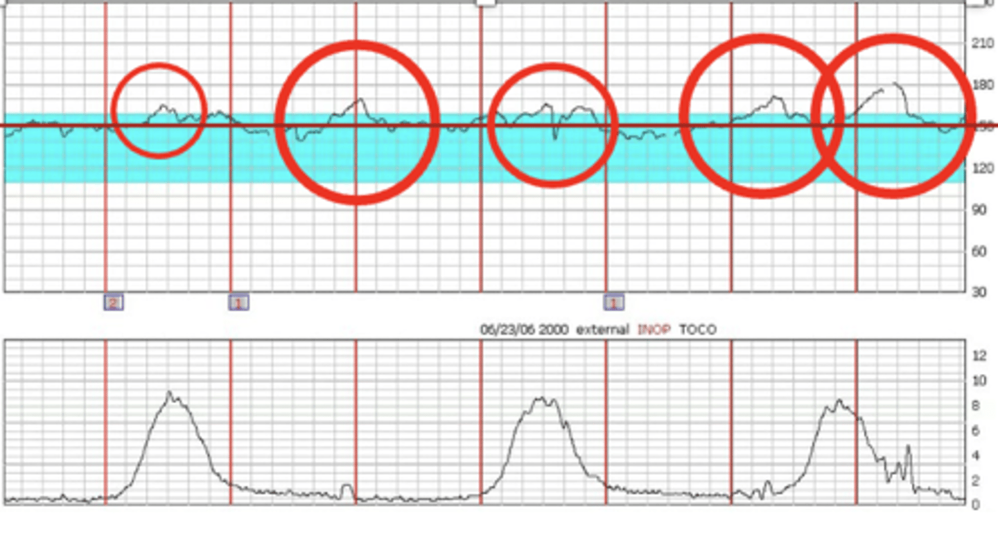 <p>abrupt increase in FHR above baseline</p><p>- Positive thing to tell us baby is moving and placenta is working</p>