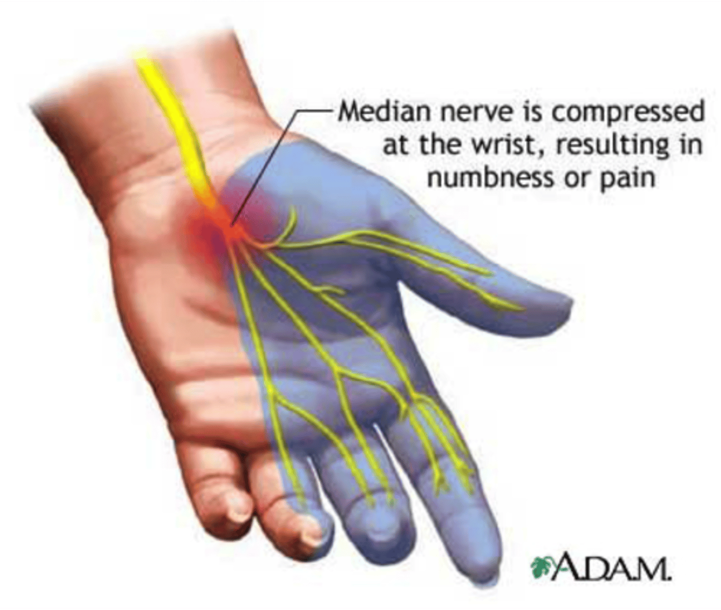 <p>Compression of the median nerve; pain, numbness, tingling along median nerve distribution, eventual weakness &amp; thenar atrophy if chronic</p>