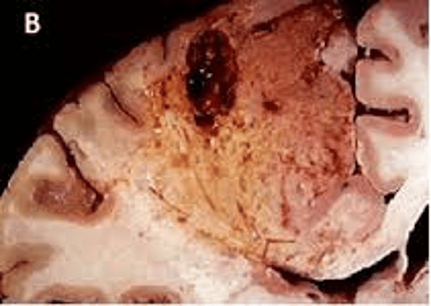 <p>transformation of tissue into a liquid viscous mass (characterized by digestion of the dead cells)</p>
