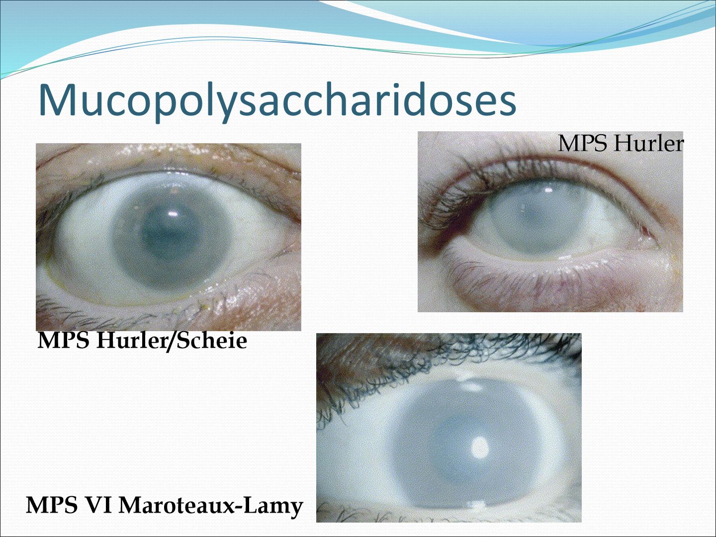 <p>What is Mucopolysaccharidoses?</p>