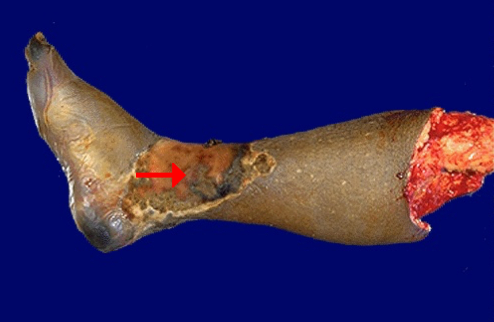 <ol><li><p>Gangrenous necrosis</p></li></ol><p></p>