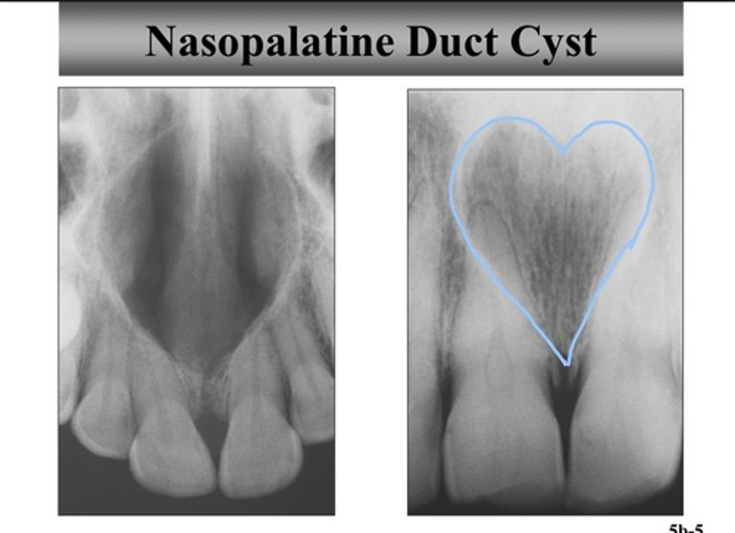 <p>- cause: arises from epithelial remnants of embryonic tissue duct</p><p>- population: middle aged males (40-60)</p><p>- clinical features: pink swelling of incisive papilla area ; teeth are VITAL</p><p>- radiographic features: well-defined radio lucency between maxillary incisors - "heart shaped"</p>