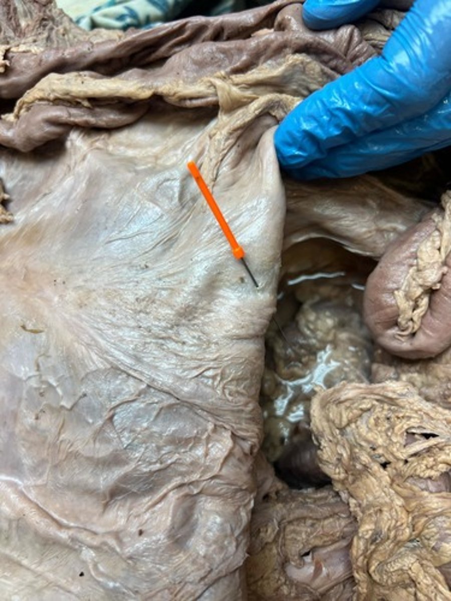<p>medial umbilical fold</p>