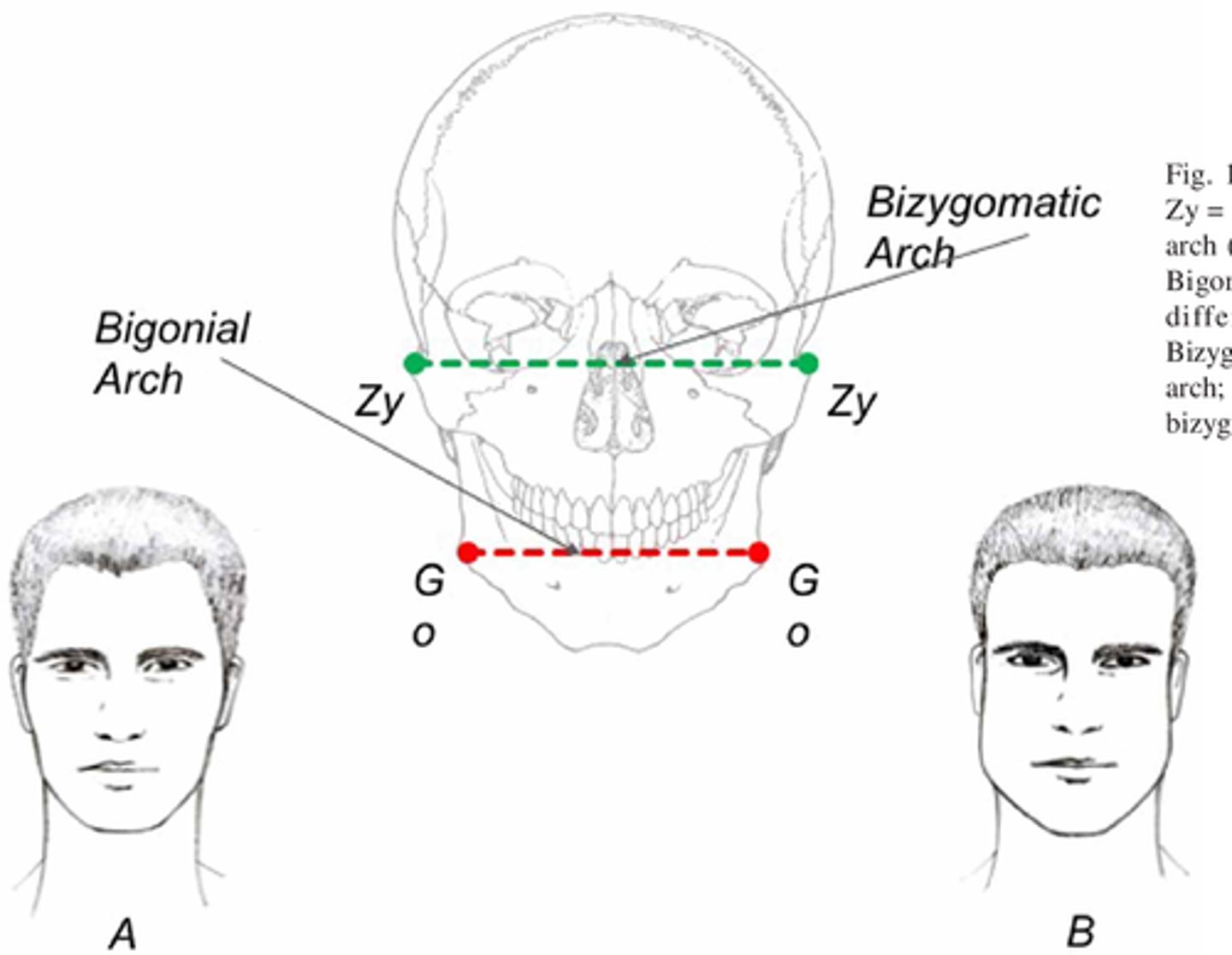 <p>Measure the widest part of the anterior plane of the face; Significant to RA in that it indicates the area for rouge cosmetic placement.</p>