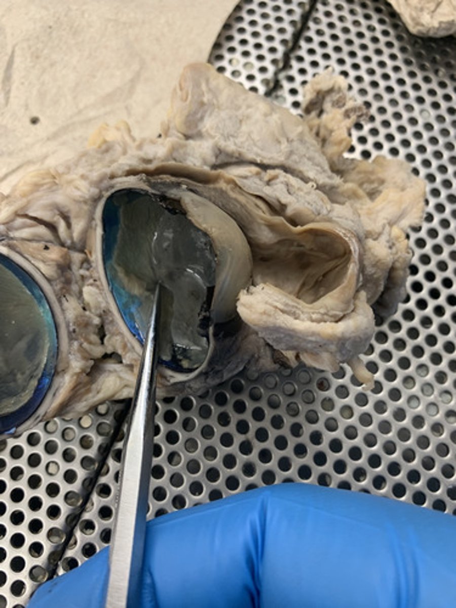 <p>Region at the back of the eye where the optic nerve meets the retina. It is the blind spot of the eye because it contains only nerve fibers, no rods or cones, and is thus insensitive to light.</p>