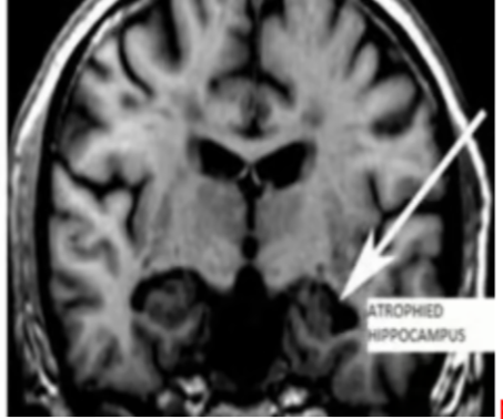 <p>The image above most likely is from a patient with</p>