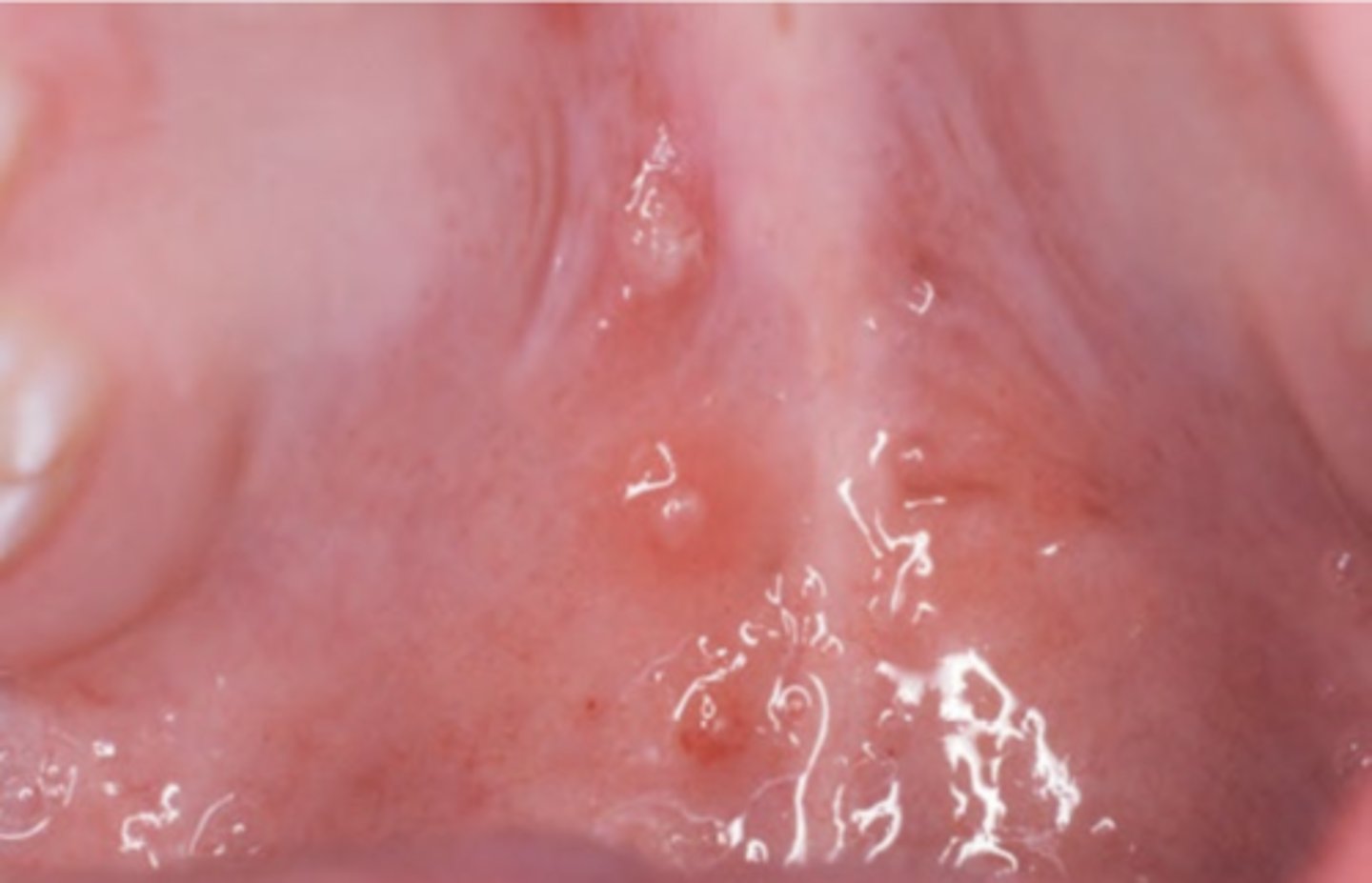<p>Hint: lesions usually painless, common and may precede skin lesions; White opaque vesicles on hard palate</p>