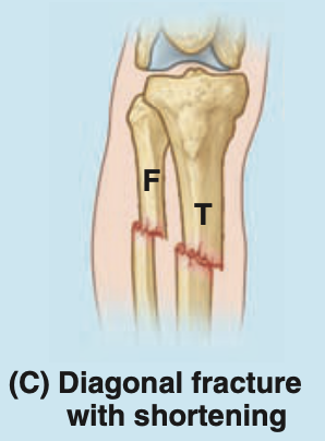 <p>because its anterior surface is subcutaneous</p>
