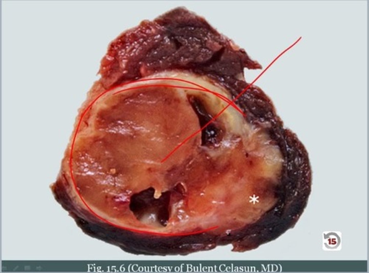 <p>benign encapsulated tumor with follicular cell differentiation</p><p>-seen surrounded by a thin fibrous capsule</p>
