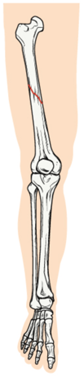 <p>A fracture in which the bone has been twisted apart</p>