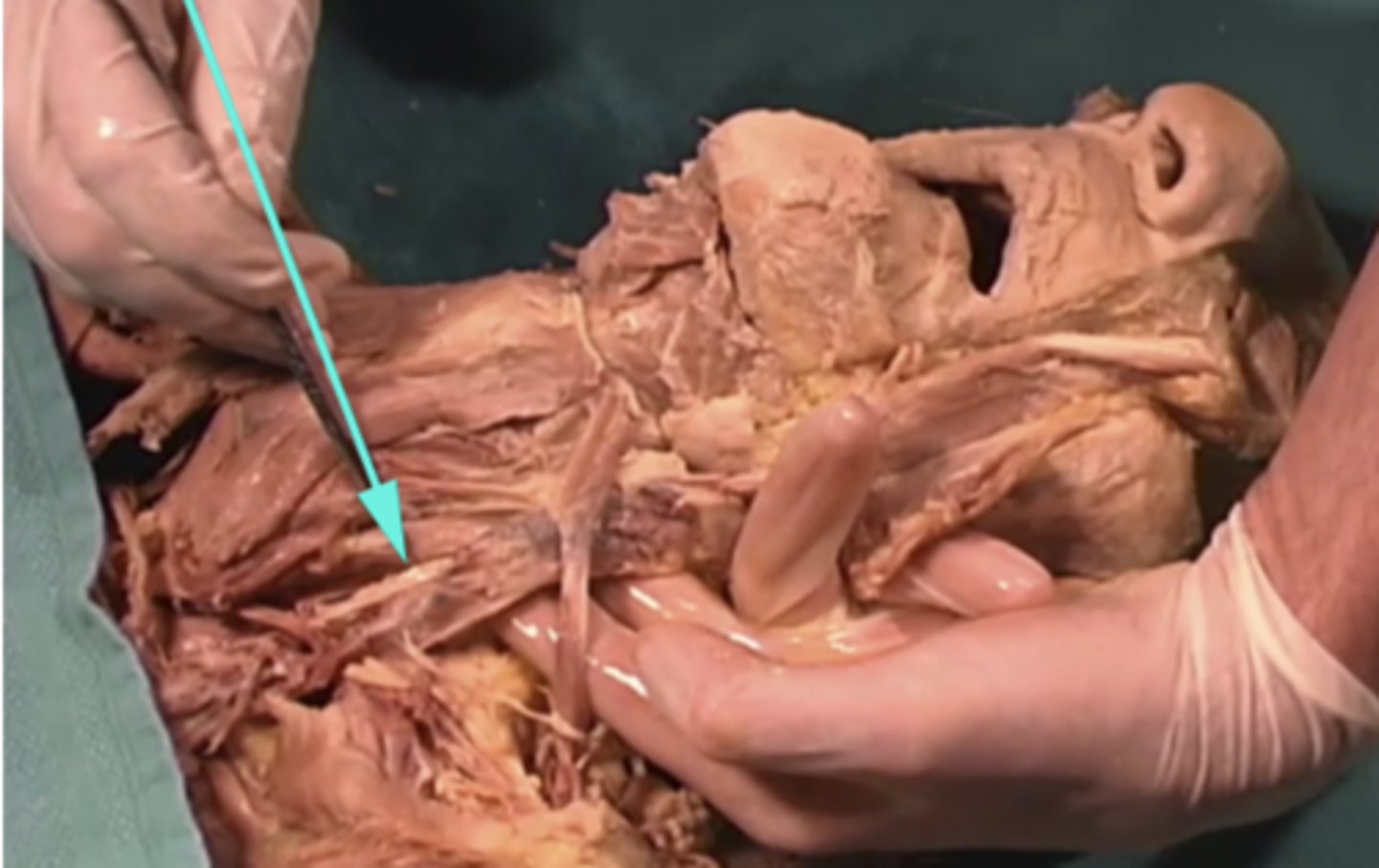 <p>Which nerve is this to which the arrow is pointing?</p><p>-Cranial nerve IX (9)</p><p>-subcutaneous fascia</p><p>-vagus nerve</p><p>-Cranial nerve VII (7)</p>