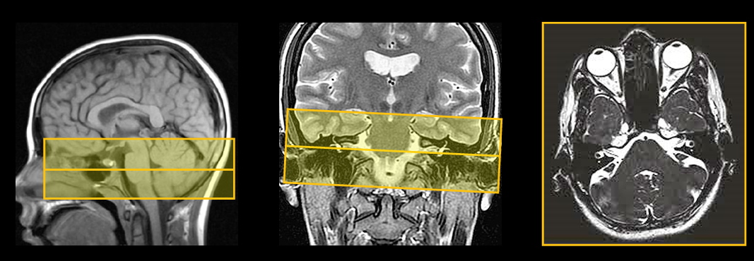 <p>Slice angulation for axial IAC: Sagittal and coronal</p>