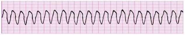<p>What does this EKG show? </p>