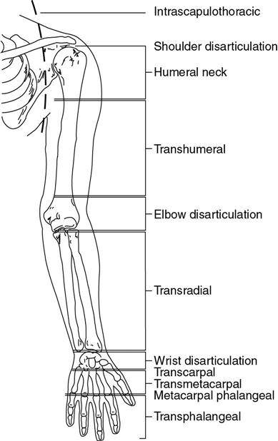 <ol><li><p>forequarter: loss of scapula, clavicle, and UE</p></li><li><p>shoulder disarticulation: entire UE</p></li><li><p>transhumeral (long &amp; short)</p></li><li><p>elbow disarticulation: distal to elbow joint</p></li><li><p>transradial (long and short)</p></li><li><p>wrist disarticulation: distal to wrist joint</p></li><li><p>transmetacarpal</p></li><li><p>finger</p></li></ol><p></p>