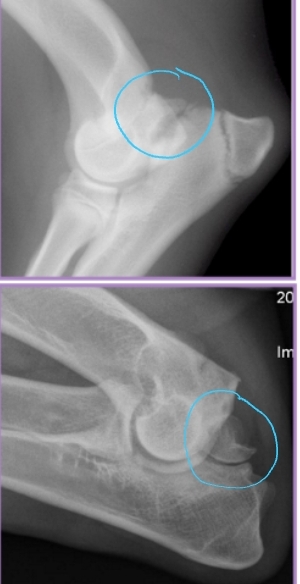 <ul><li><p><span style="background-color: transparent;"><strong><span>Et:</span></strong></span><span style="background-color: transparent; color: red;"><strong><span> </span></strong><span>Anconeal process of ulna fails to unite with proximal ulnar metaphysis</span></span></p><ul><li><p><span style="background-color: transparent;"><span>Failure of endochondral ossification, Joint incongruity</span></span></p></li><li><p><span style="background-color: transparent;"><span>Hereditary, environmental, hormonal factors</span></span></p></li></ul></li><li><p><span style="background-color: transparent;"><strong><span>Sig: </span></strong></span><span style="background-color: transparent; color: red;"><strong><span>Large breeds, </span><u><span>GSD</span></u><span>, Male > female, 5-12 months</span></strong></span></p></li><li><p><span style="background-color: transparent;"><strong><span>Dt:</span></strong><span> </span><strong><span>Radiographs FLEXED lateral!</span></strong></span></p><ul><li><p><span style="background-color: transparent;"><span>Osteophytes, Effusion, Anconeal process fragment, Joint incongruity</span></span></p></li></ul></li></ul><ul><li><p><span style="background-color: transparent;"><strong><span>Tx:</span></strong></span></p><ul><li><p><span style="background-color: transparent;"><strong><span>Rx:</span></strong><span> OA management</span></span></p><ul><li><p><span style="background-color: transparent;"><u><span>End stage or financial issues</span></u><span> </span></span></p></li></ul></li><li><p><span style="background-color: transparent;"><strong><span>Sx: </span></strong></span><span style="background-color: transparent; color: red;"><span>#1 , <1yr - early sx **</span></span></p><ul><li><p><span style="background-color: transparent;"><strong><span>Early: </span></strong><span>primary repair, viable cartilage </span></span></p></li><li><p><span style="background-color: transparent;"><strong><span>Ulnar osteotomy</span></strong><span> → remove stress, allow fusion</span></span></p></li><li><p><span style="background-color: transparent;"><strong><span>Lag screw</span></strong><span> fixation of anconeal process</span></span></p></li><li><p><span style="background-color: transparent;"><strong><span>Chronic: excision </span></strong><span>of anconeal process</span></span></p></li></ul></li></ul></li></ul><p></p>