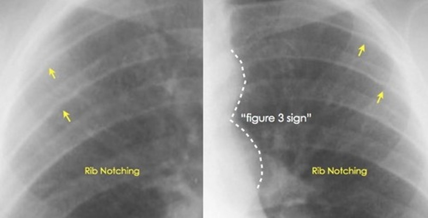 <p>Figure 3 sign; inferior notching of the ribs</p>