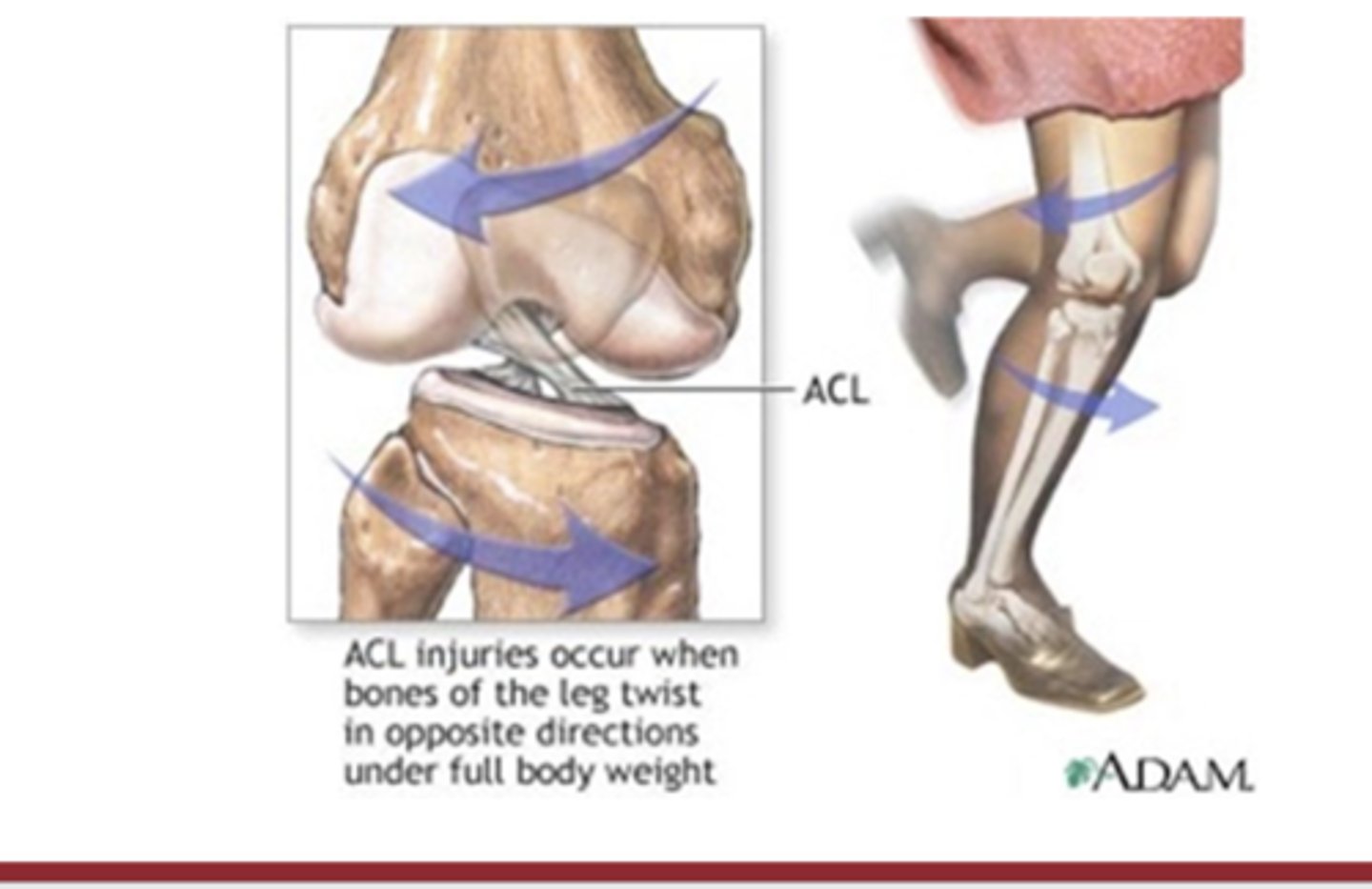 <p>non-contact ACL rupture (tears by ____) … tibia sticks, femur twists</p>