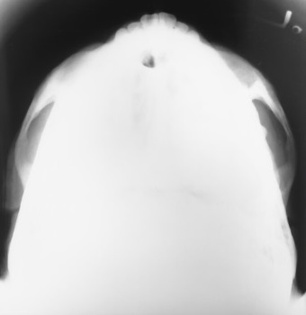 <p>What is this x-ray demonstrating?</p>