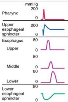 <p>What condition is this pattern from the esophageal manometry showing?</p>