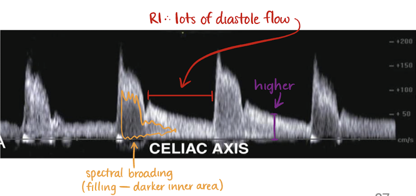 <ul><li><p><u>low resistant</u> waveform (sharp brisk upstroke; significant diastolic flow)</p></li><li><p>has <u>spectral broadening</u></p></li><li><p>no change in flow after meals</p></li></ul><p></p>